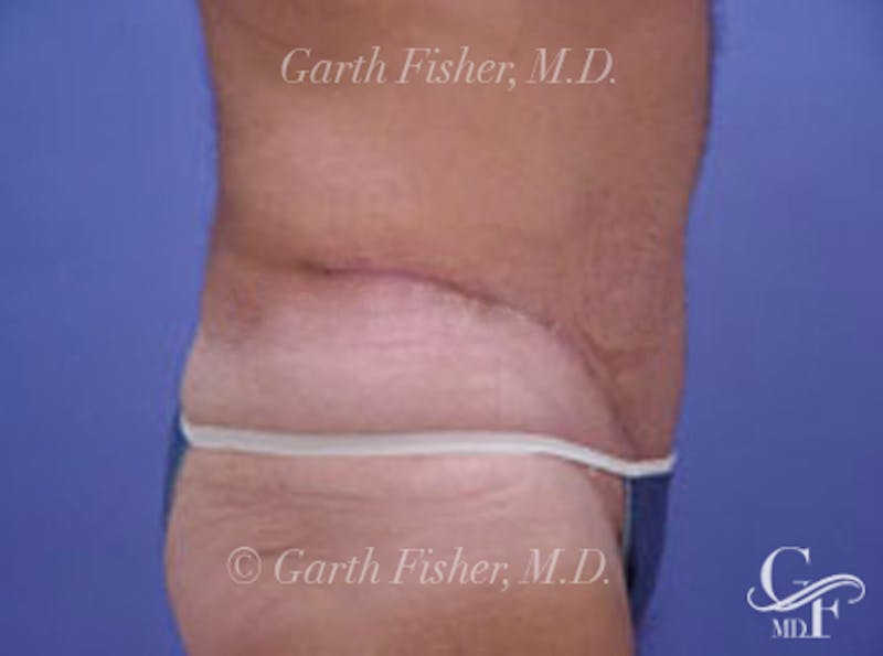 Tummy Tuck Before & After Gallery - Patient 242707 - Image 6