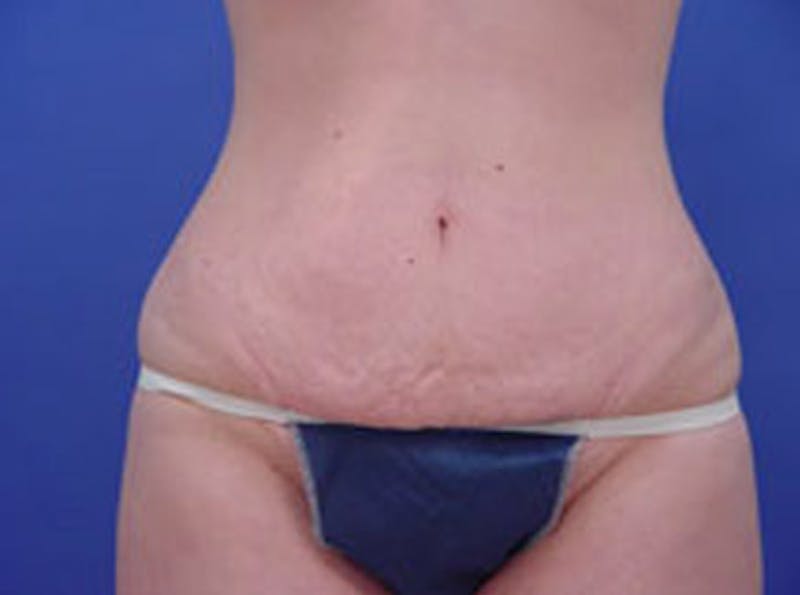 Tummy Tuck Before & After Gallery - Patient 399132 - Image 1