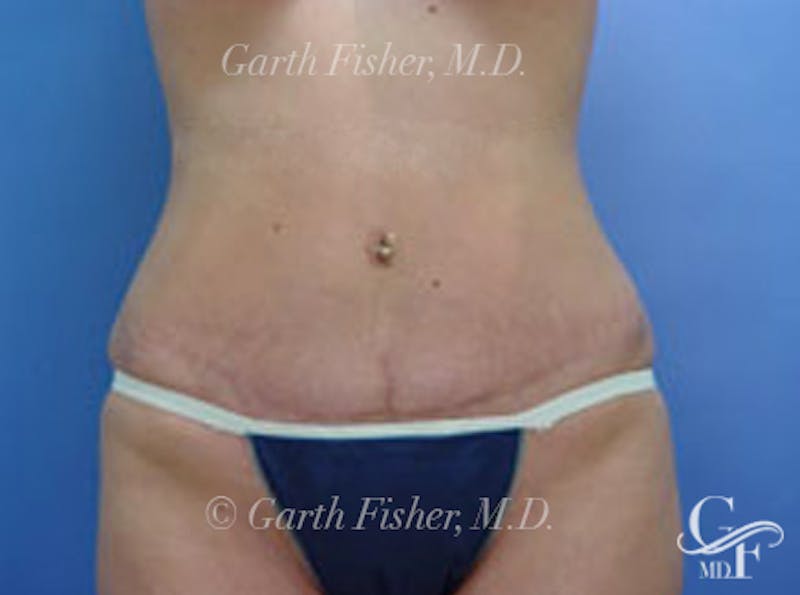 Tummy Tuck Before & After Gallery - Patient 399132 - Image 2