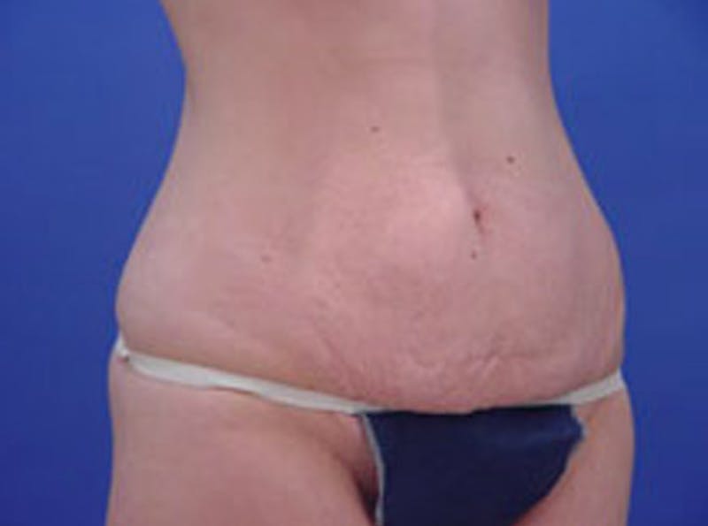 Tummy Tuck Before & After Gallery - Patient 399132 - Image 3