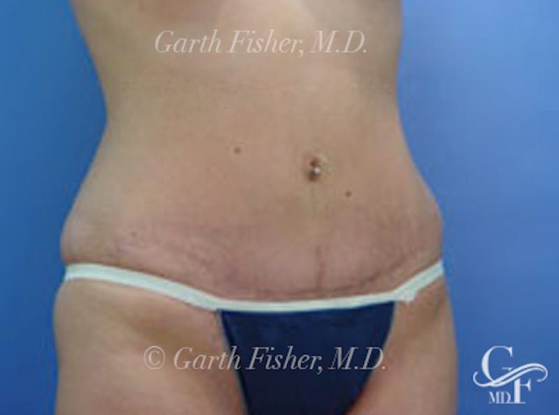 Tummy Tuck Before & After Gallery - Patient 399132 - Image 4