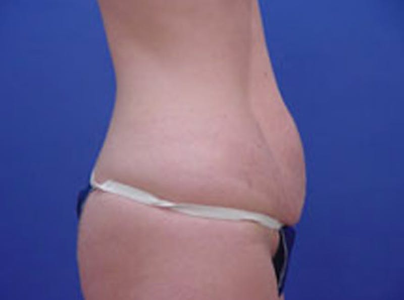Tummy Tuck Before & After Gallery - Patient 399132 - Image 5