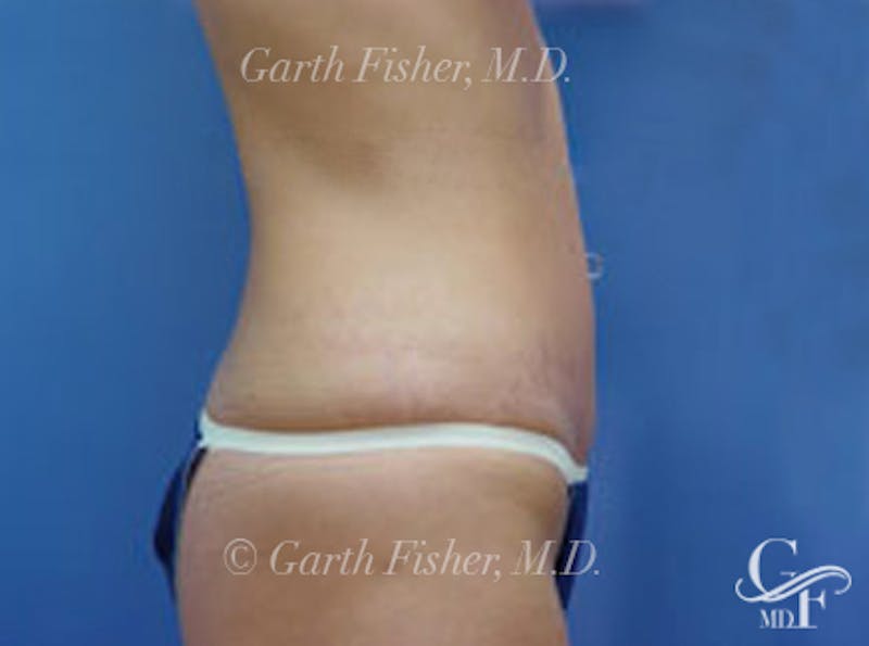 Tummy Tuck Before & After Gallery - Patient 399132 - Image 6
