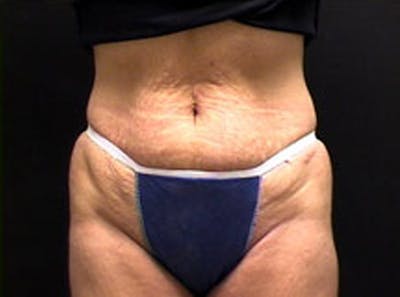 Tummy Tuck Before & After Gallery - Patient 180352 - Image 1