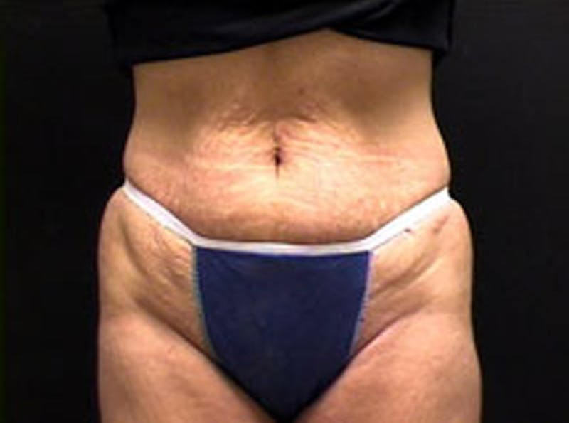 Tummy Tuck Before & After Gallery - Patient 180352 - Image 1