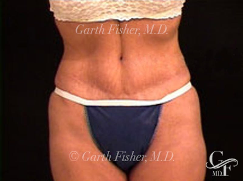 Tummy Tuck Before & After Gallery - Patient 180352 - Image 2