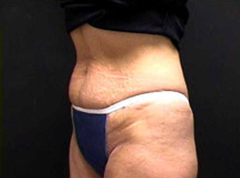 Tummy Tuck Before & After Gallery - Patient 180352 - Image 3