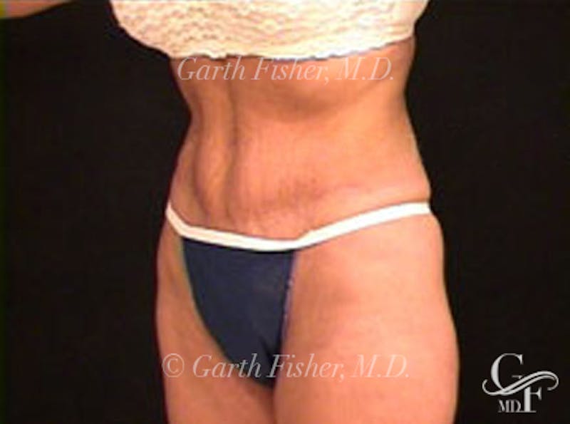 Tummy Tuck Before & After Gallery - Patient 180352 - Image 4