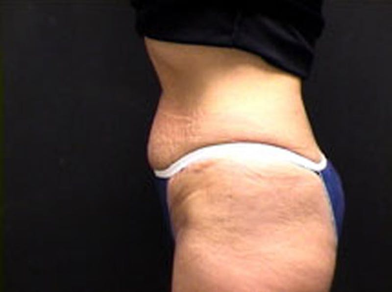 Tummy Tuck Before & After Gallery - Patient 180352 - Image 5
