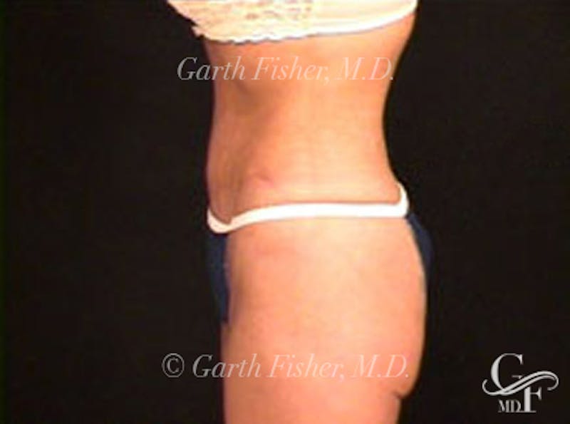 Tummy Tuck Before & After Gallery - Patient 180352 - Image 6