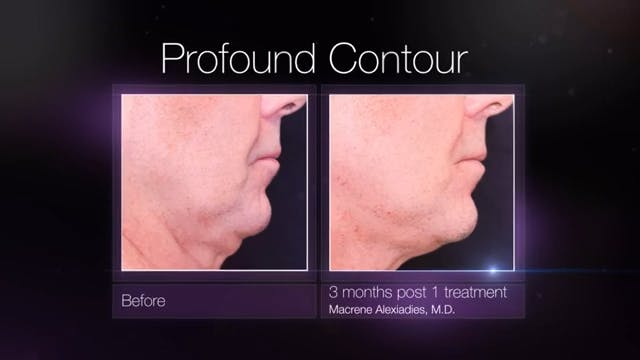 Before and 3 months post op comparison of patients neck and chin area