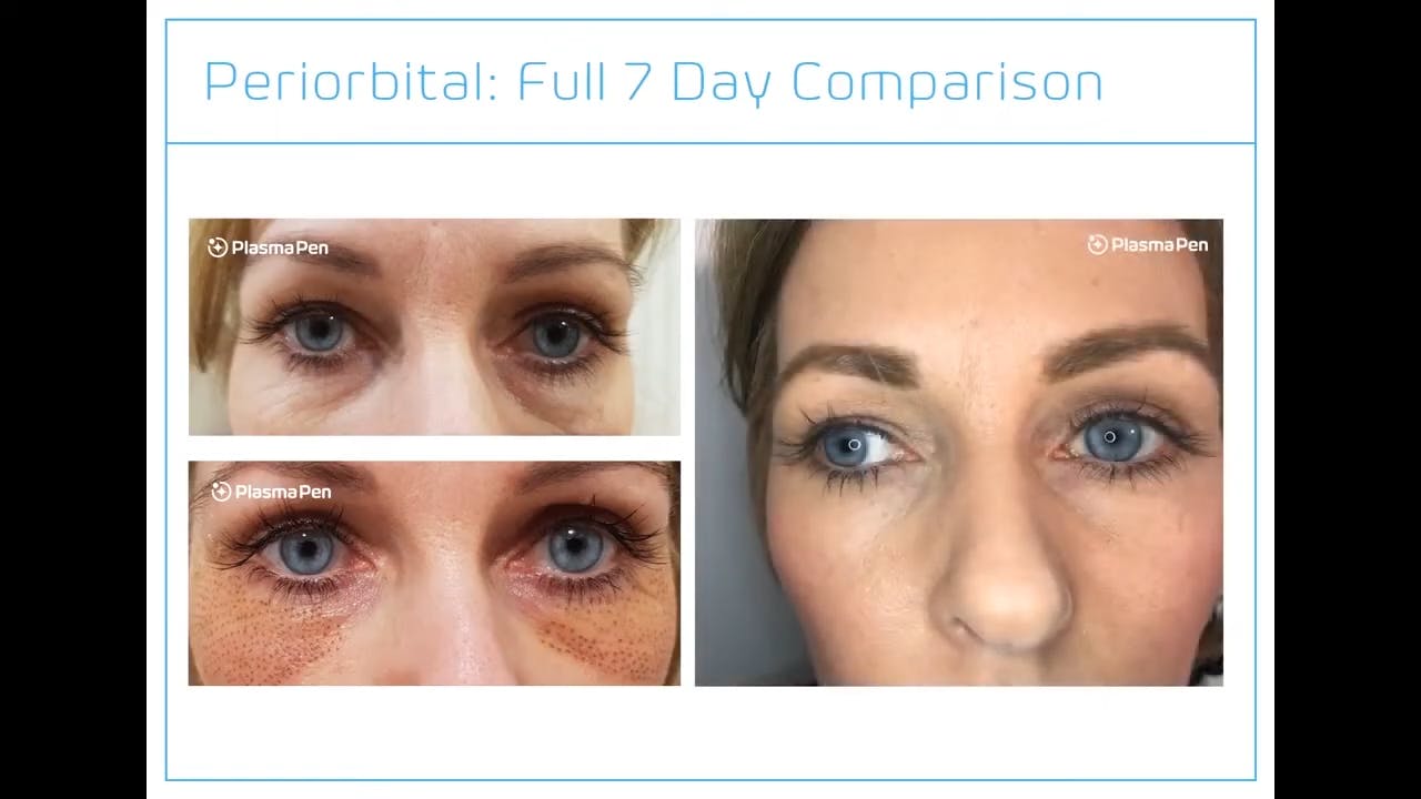 7 day comparison of patient who had a plasma pen treatment for her under eye area