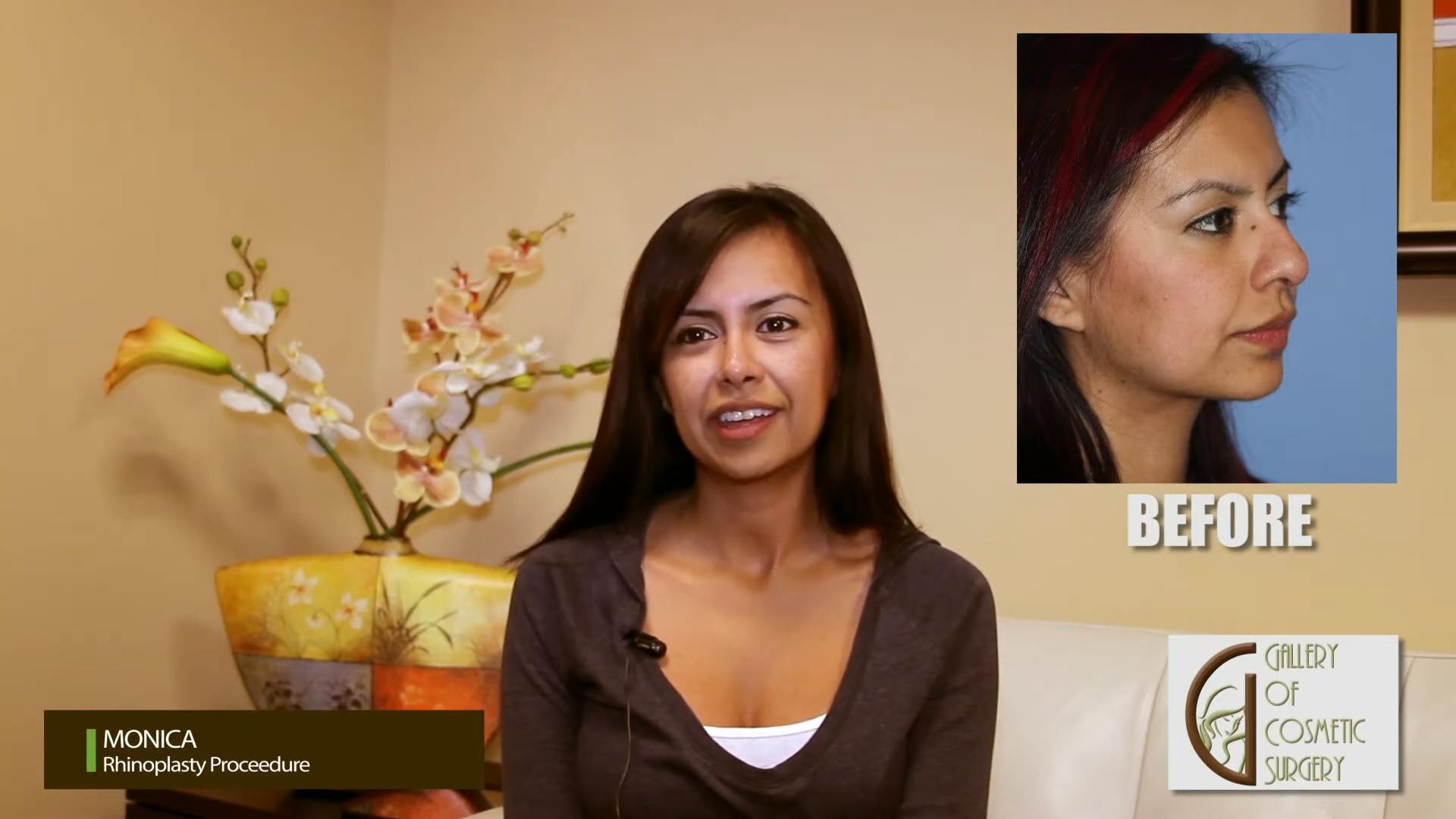 Patient talks about her rhinoplasty procedure after being 6 months post op