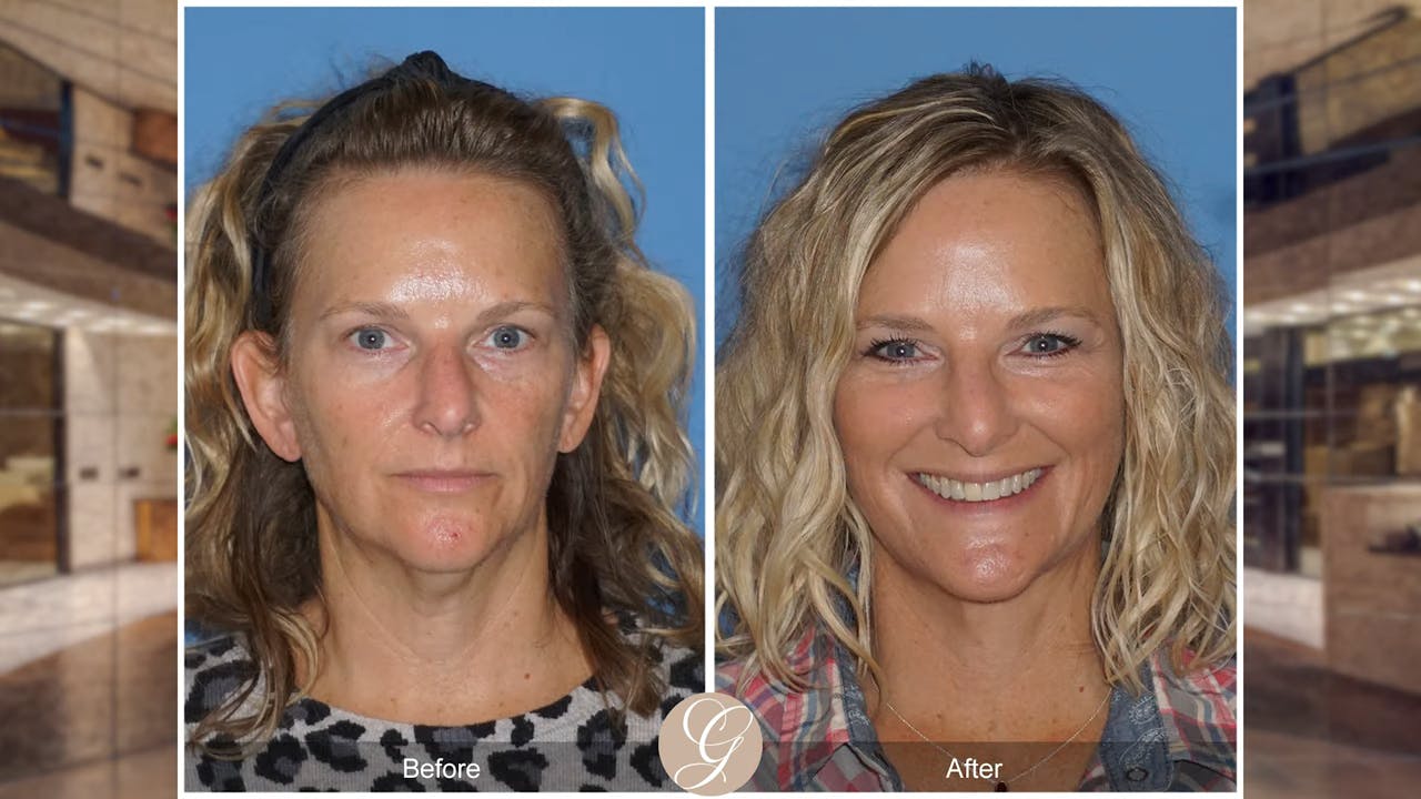 Real Patient Facelift Before and After Photos