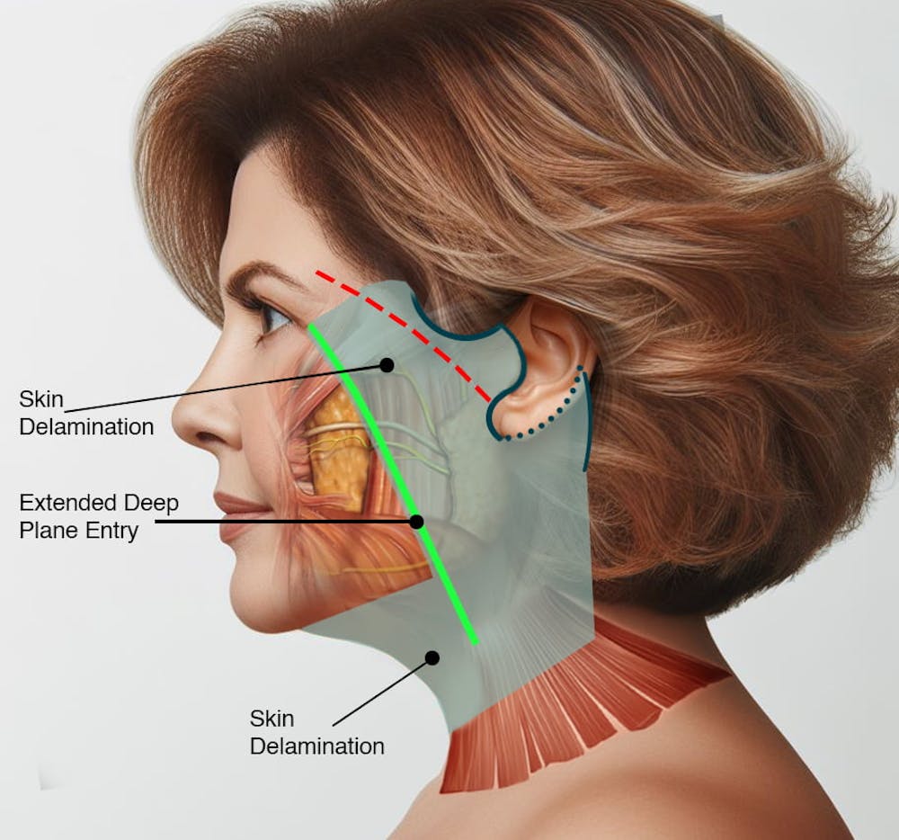 Estiramiento facial profundo versus estiramiento facial preservado