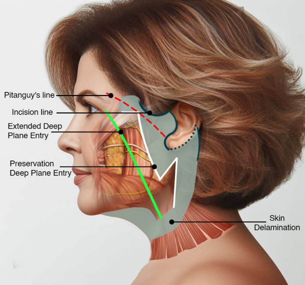 Estiramiento facial profundo versus estiramiento facial preservado