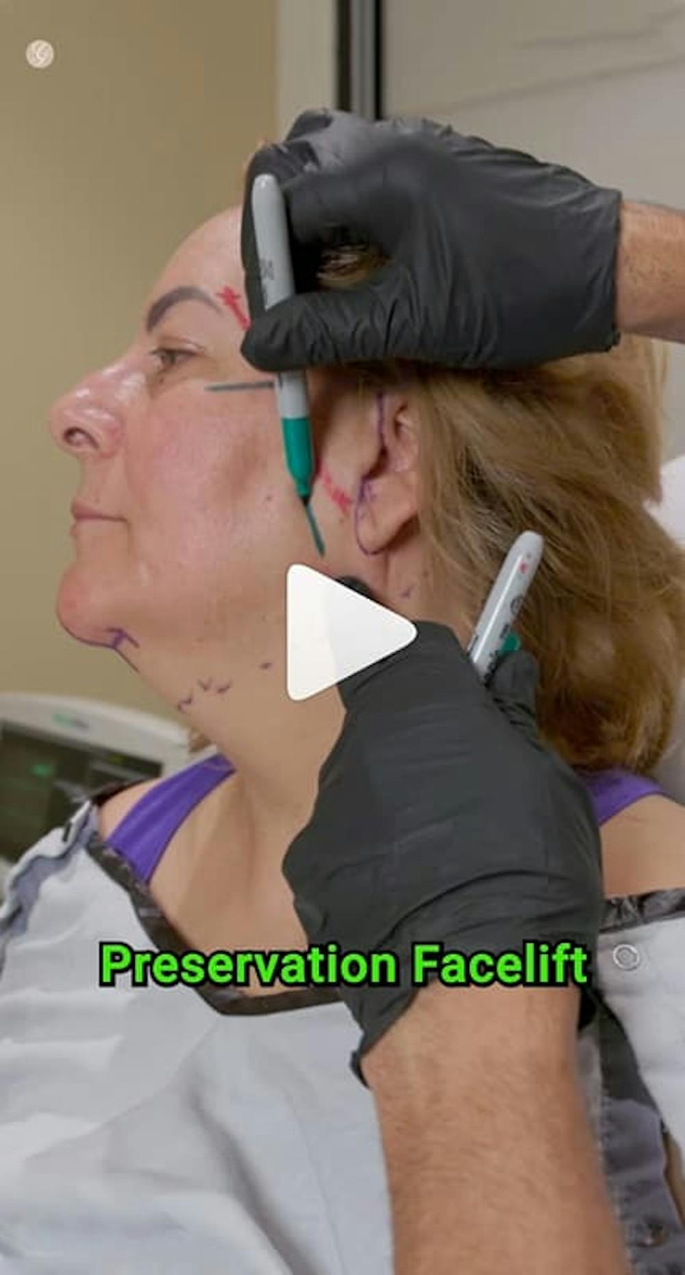 10 cosas que debes saber antes de hacerte un lifting facial: la guía experta del Dr. Kevin Sadati