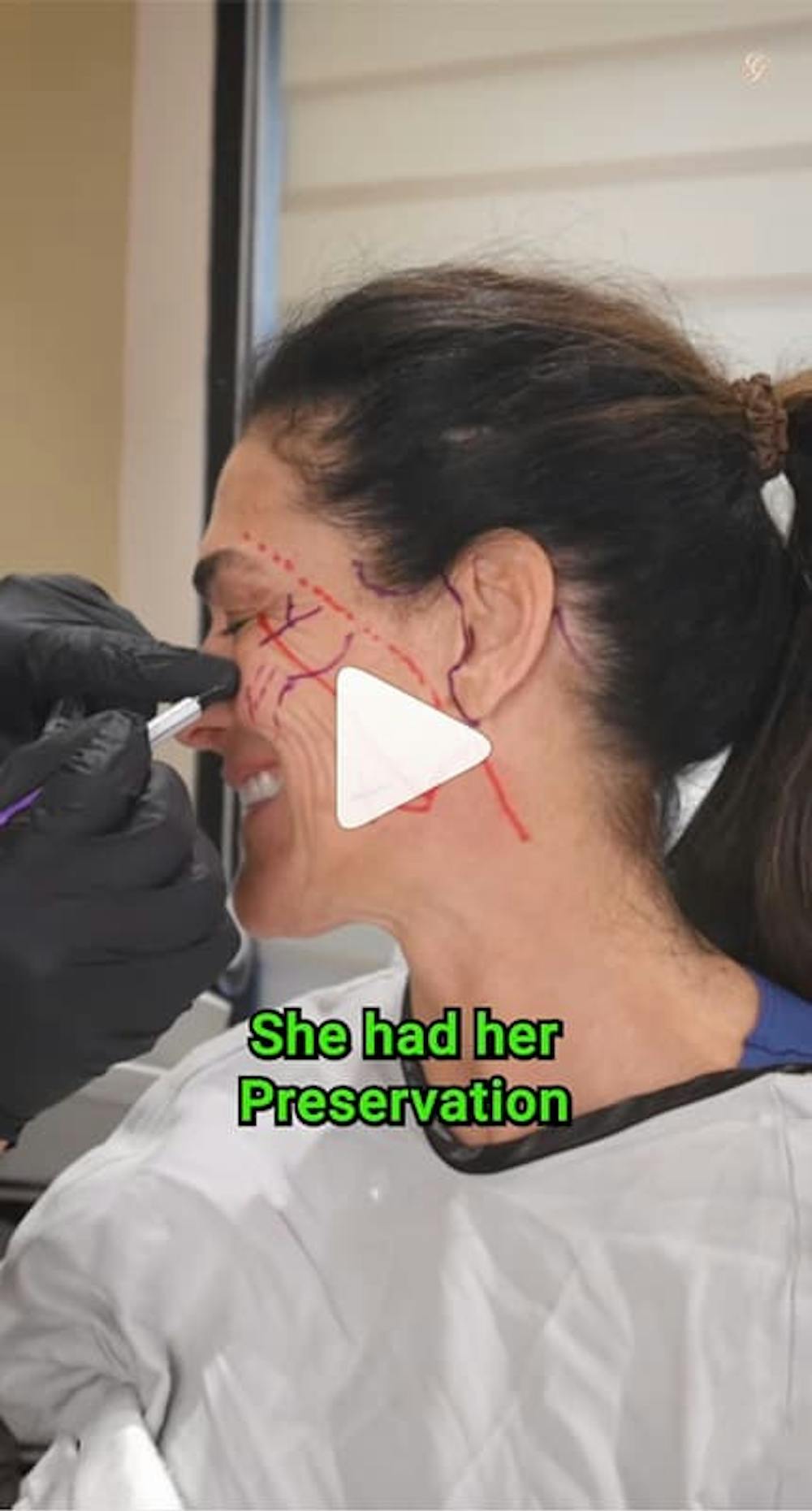 10 cosas que debes saber antes de hacerte un lifting facial: la guía experta del Dr. Kevin Sadati