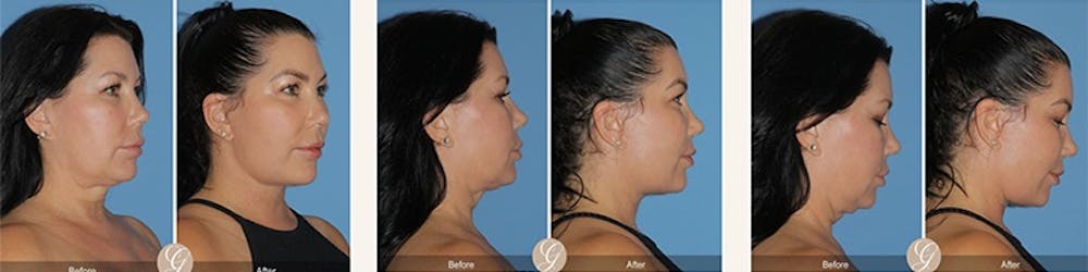 El lifting moderno: liftings faciales que te hacen lucir como tú sin esfuerzo