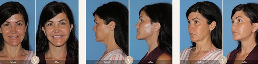 El lifting moderno: liftings faciales que te hacen lucir como tú sin esfuerzo
