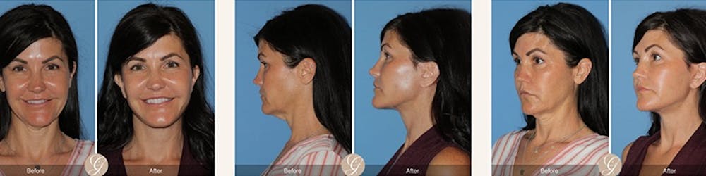 El lifting moderno: liftings faciales que te hacen lucir como tú sin esfuerzo
