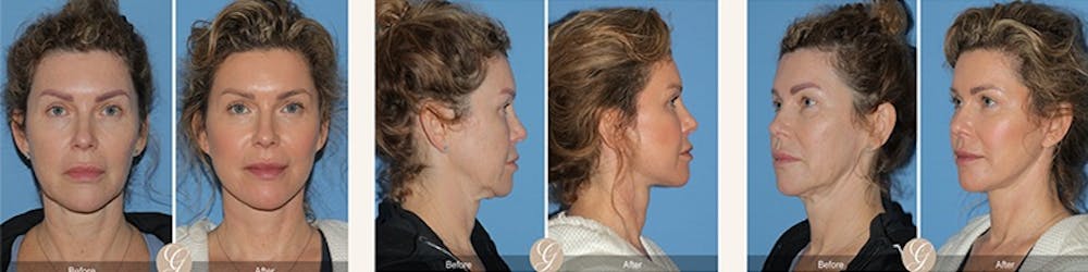 El lifting moderno: liftings faciales que te hacen lucir como tú sin esfuerzo