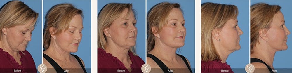 El lifting moderno: liftings faciales que te hacen lucir como tú sin esfuerzo