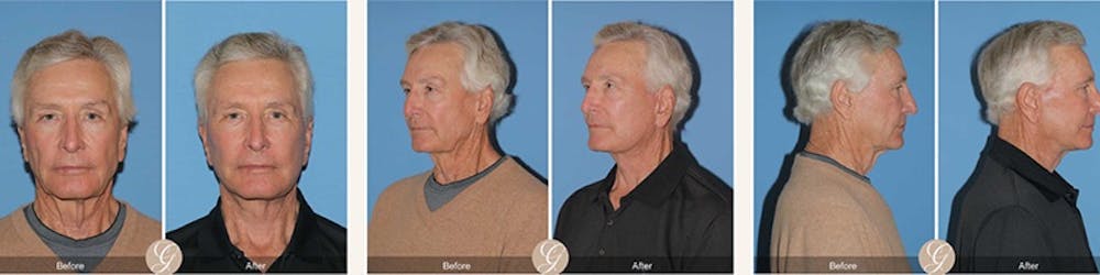 Modelo de paciente de lifting facial antes y despu&eacute;s 1