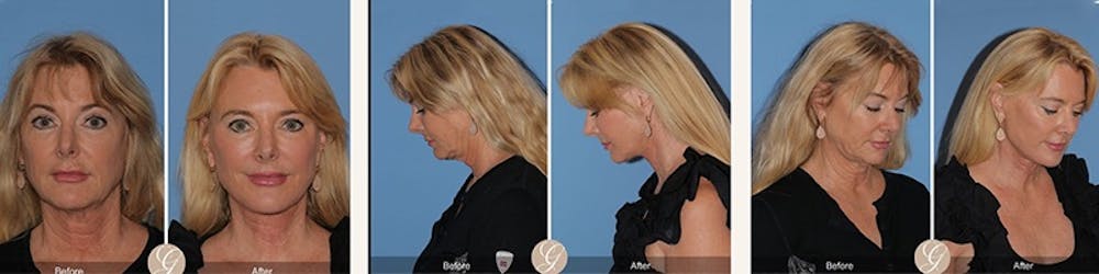 Modelo de paciente de lifting facial antes y despu&eacute;s 2