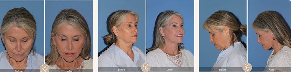Modelo de paciente de lifting facial antes y despu&eacute;s 3