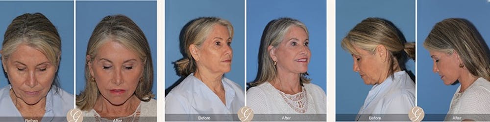 Modelo de paciente de lifting facial antes y después 3