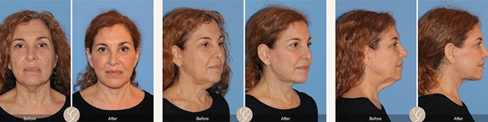 Modelo de paciente de lifting facial antes y despu&eacute;s 4