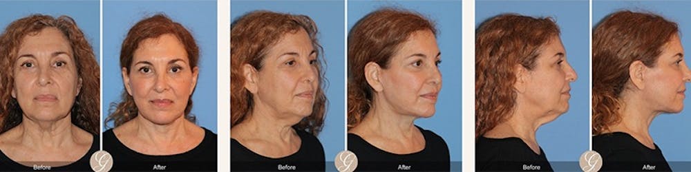 Modelo de paciente de lifting facial antes y después 4