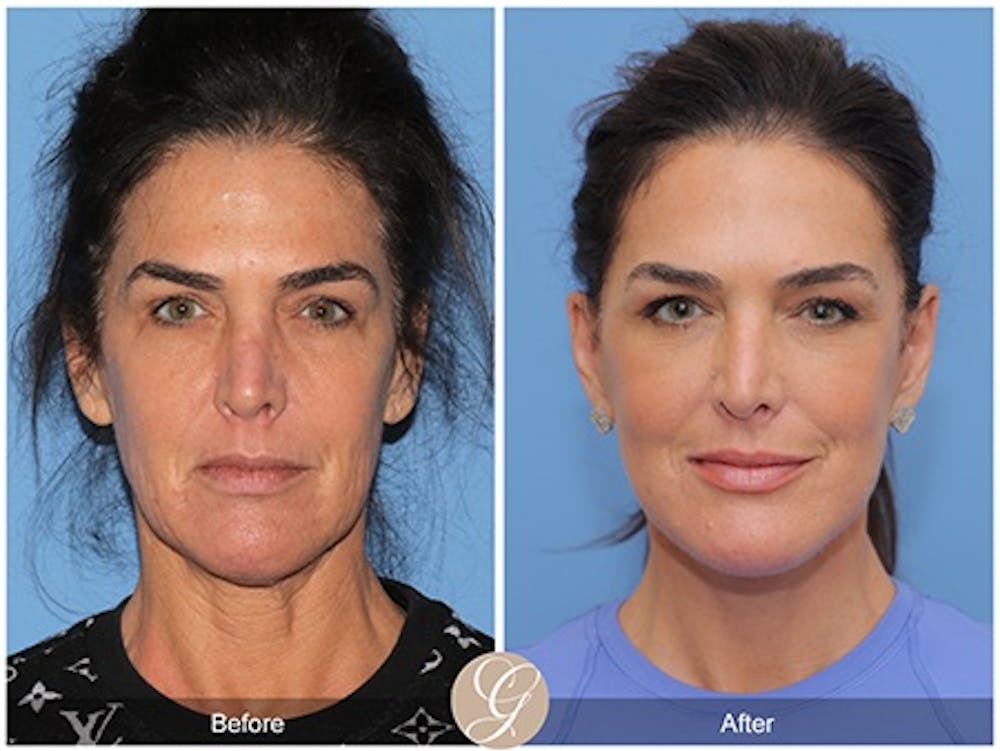 deep plane facelift patient model before and after 1