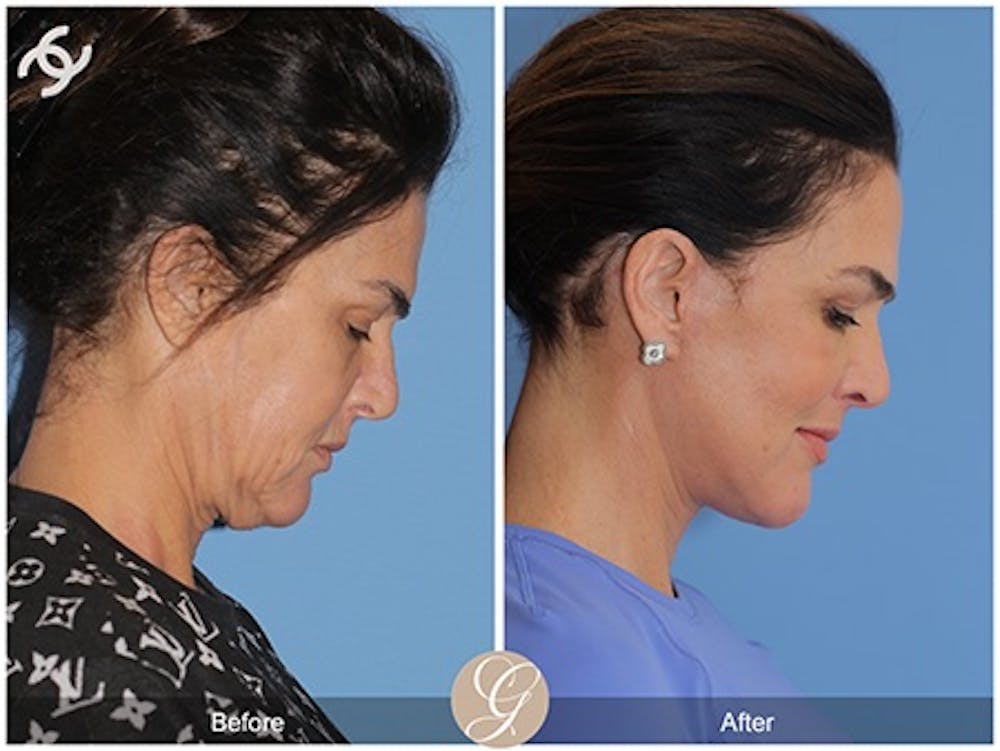 Modelo de paciente de lifting facial de plano profundo antes y después 2