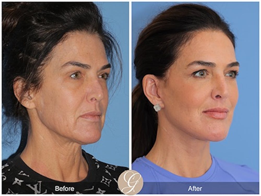Modelo de paciente de lifting facial de plano profundo antes y después 3