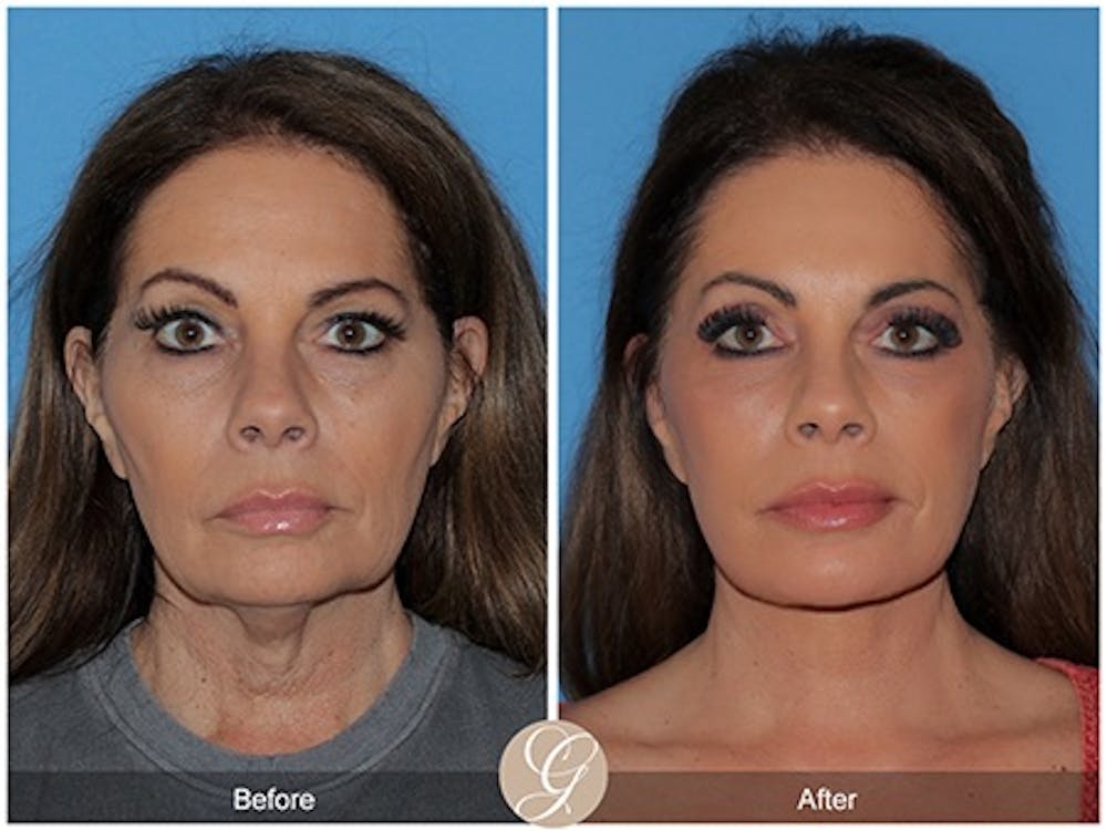 Modelo de paciente de lifting facial de plano profundo antes y después 4