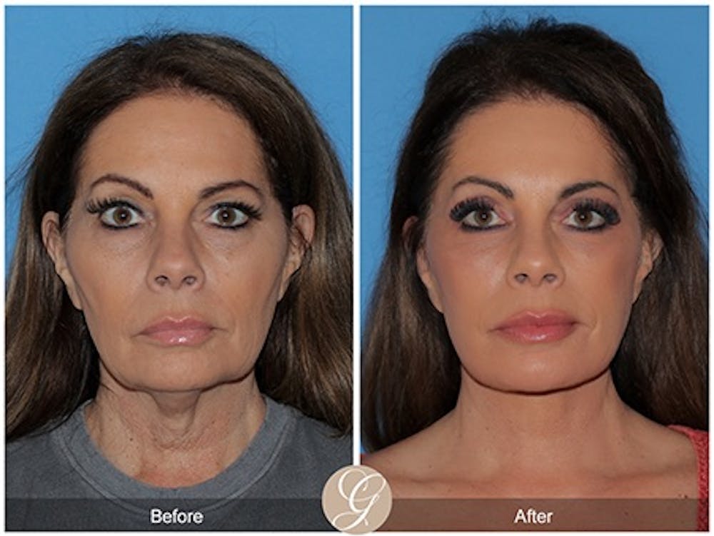 deep plane facelift patient model before and after 4