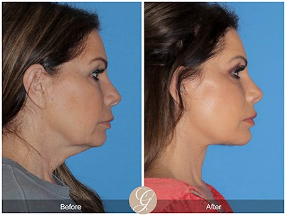 Modelo de paciente de lifting facial de plano profundo antes y después 5
