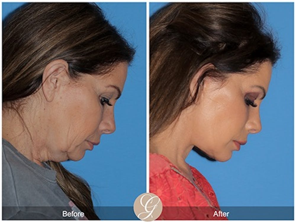 deep plane facelift patient model before and after 6