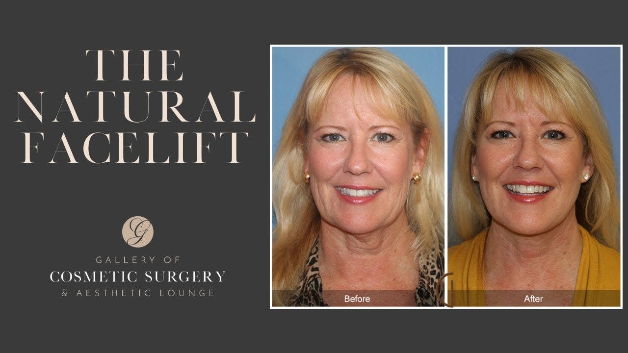 Real Facelift Patient
