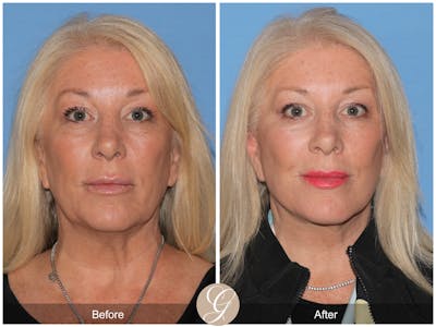 Preservation Facelift Before & After Gallery - Patient 193855 - Image 1