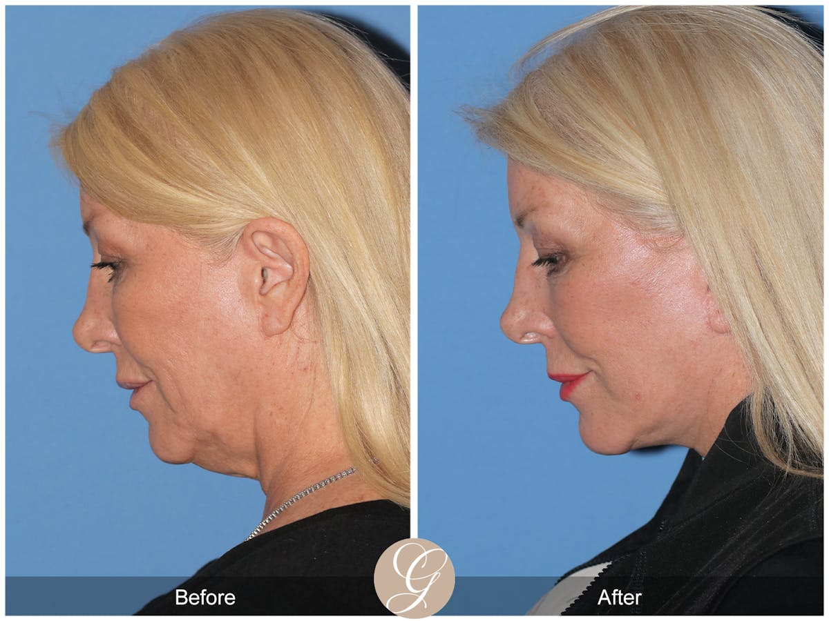 Preservation Facelift Before & After Gallery - Patient 193855 - Image 2