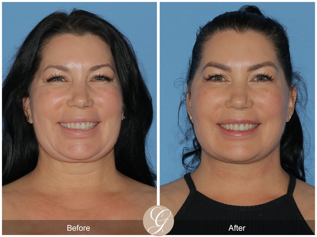 Preservation Facelift Before & After Gallery - Patient 349656 - Image 1