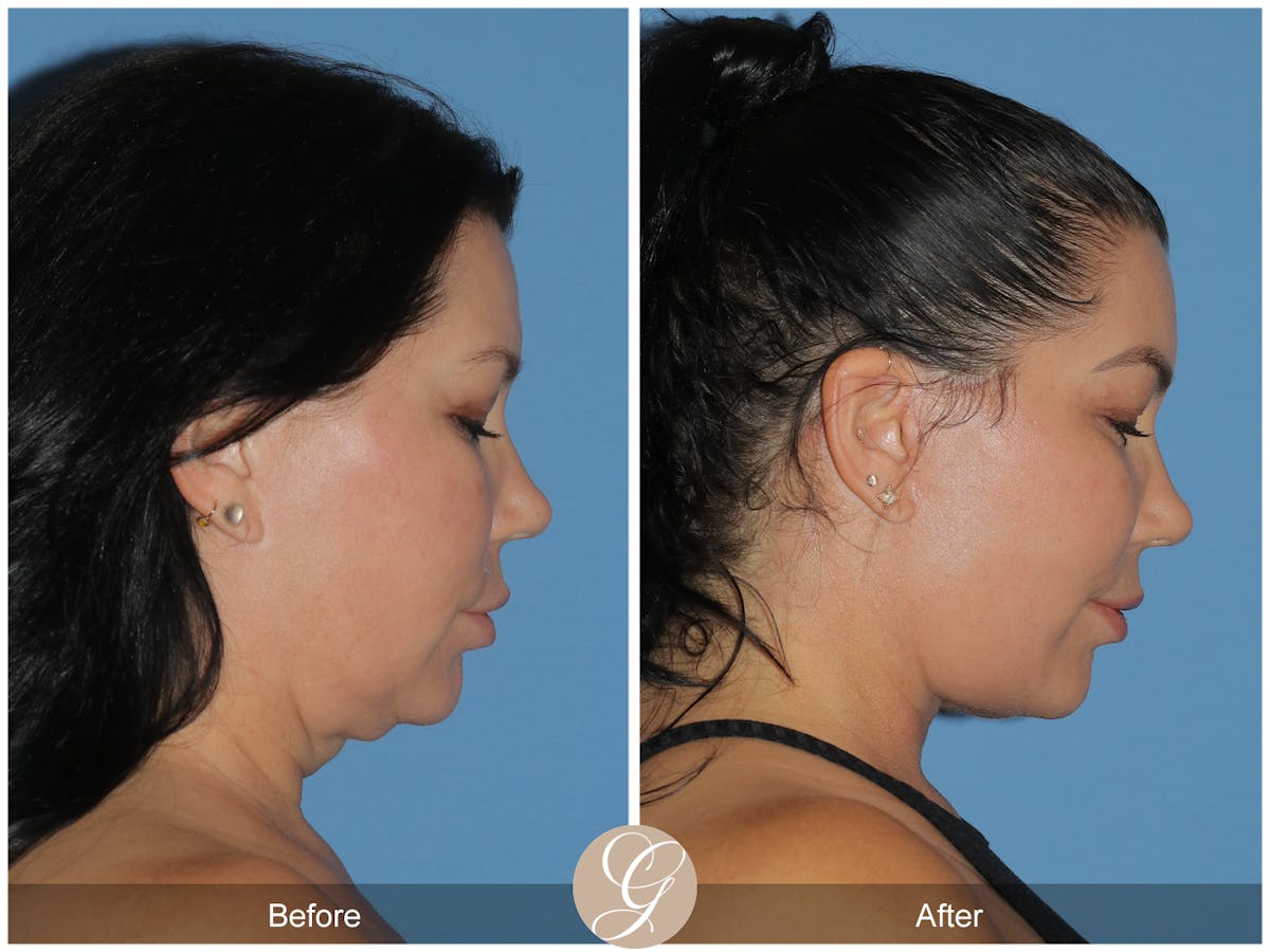 Deep Plane Facelift Before & After Gallery - Patient 285016 - Image 4