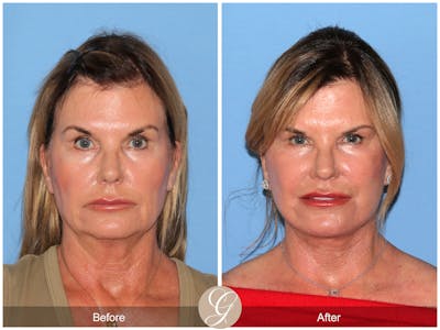Deep Plane Facelift Before & After Gallery - Patient 238097 - Image 1