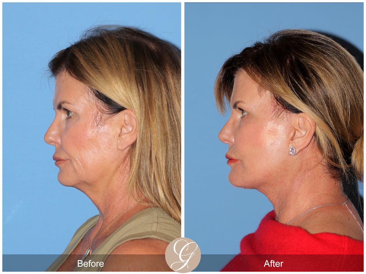 Deep Plane Facelift Before & After Gallery - Patient 238097 - Image 4