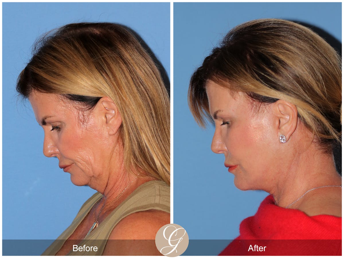 Deep Plane Facelift Before & After Gallery - Patient 238097 - Image 5