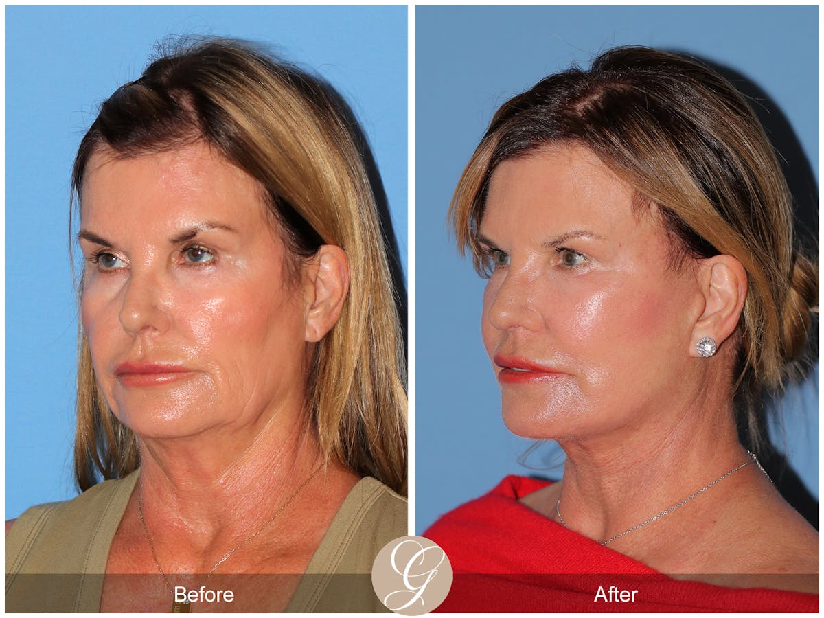Deep Plane Facelift Before & After Gallery - Patient 238097 - Image 6