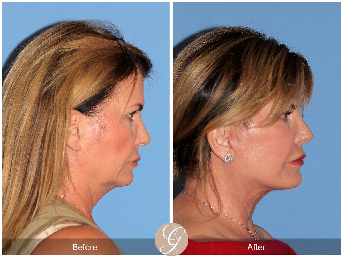 Deep Plane Facelift Before & After Gallery - Patient 238097 - Image 7